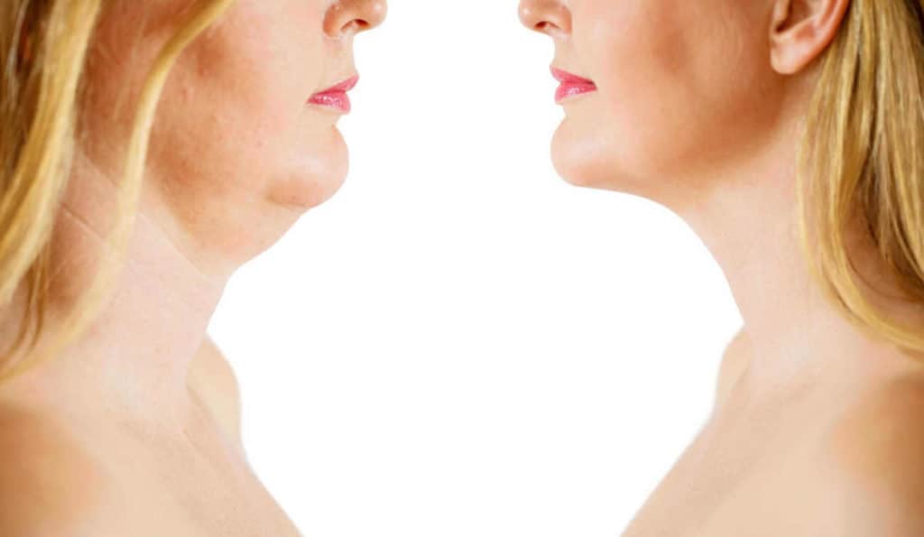 Double Chin treatment Morden before and after results