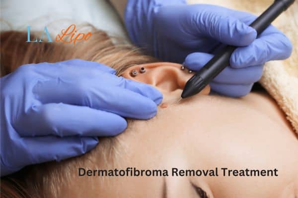 Dermatofibroma Removal Treatment Morden