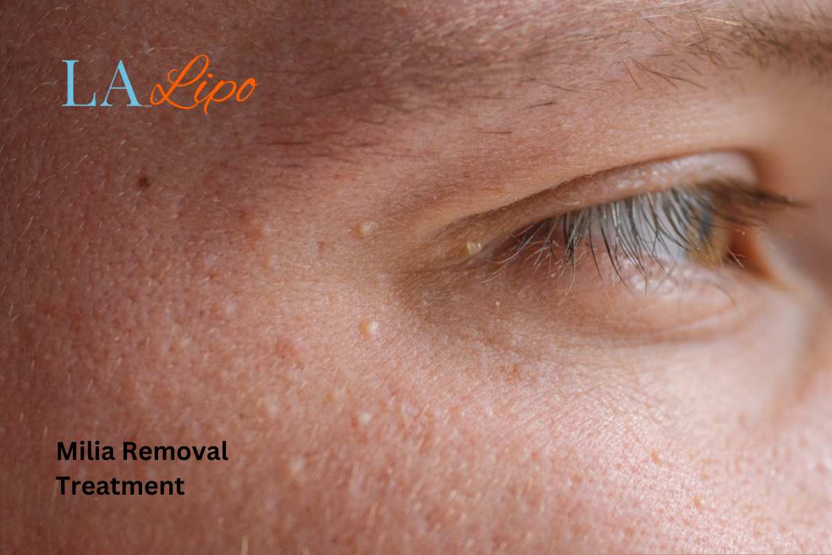 Cryopen Milia Removal: Is It the Easiest and Safest Option Morden?