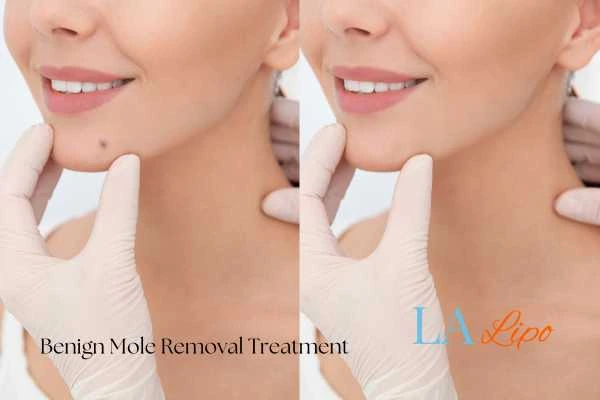 woman's before and after mole removal Morden results