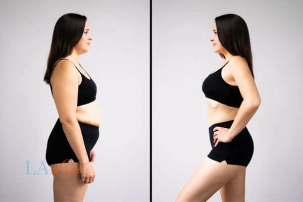 image of woman before and after results of LA-EMS Body Sculpting Morden to help treat Diastasis recti