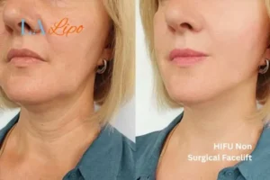 hi-fu for wrinkles Morden before and after results