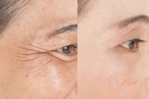 Before and after results of woman - HI-fu wrinkles reduction treatment Morden