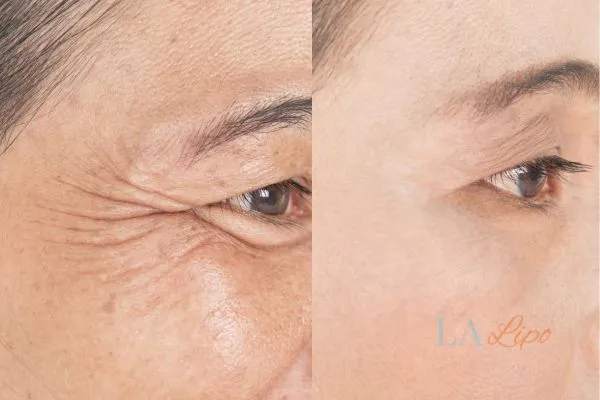 Before and after results of woman - HI-fu wrinkles reduction treatment Morden