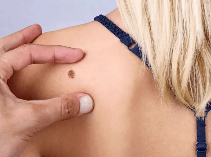 woman having mole removal Morden consultation before treatment.