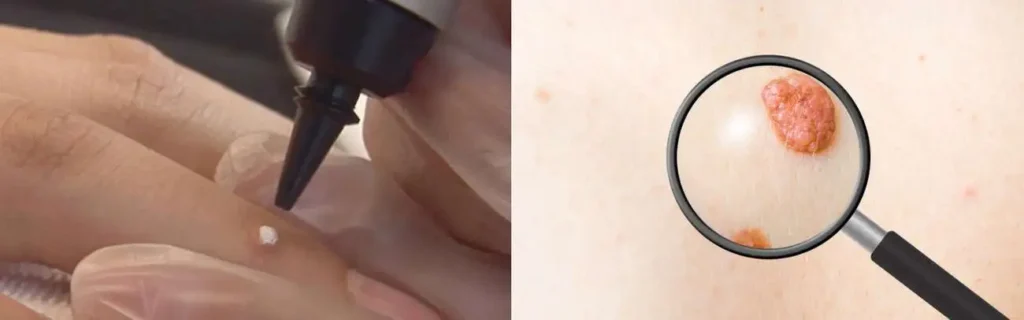 Cryopen for mole removal Morden - speak to our team today!