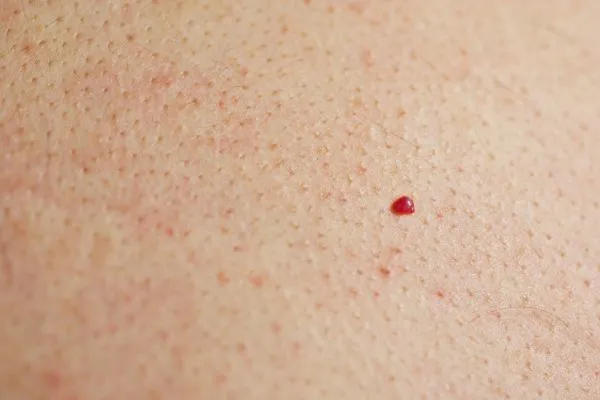close up of a cherry angioma Morden