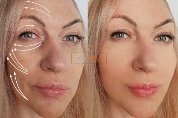 Morpheus 8 results Morden face lift.