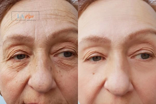 The powerful benefits of Morpheus8 Treatment Morden - Call Our team today!