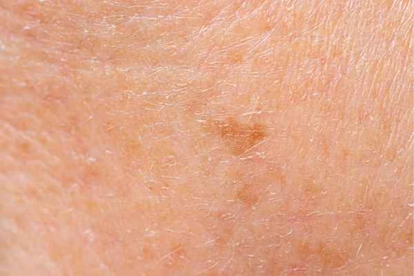 close up picture of age spots Morden