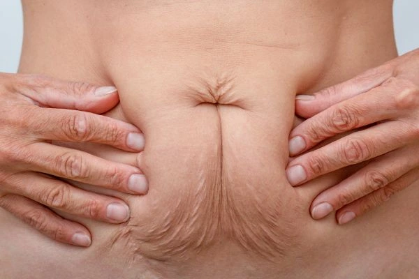 Image of a woman's stomach with loose skin - example of skin tightening Morden options