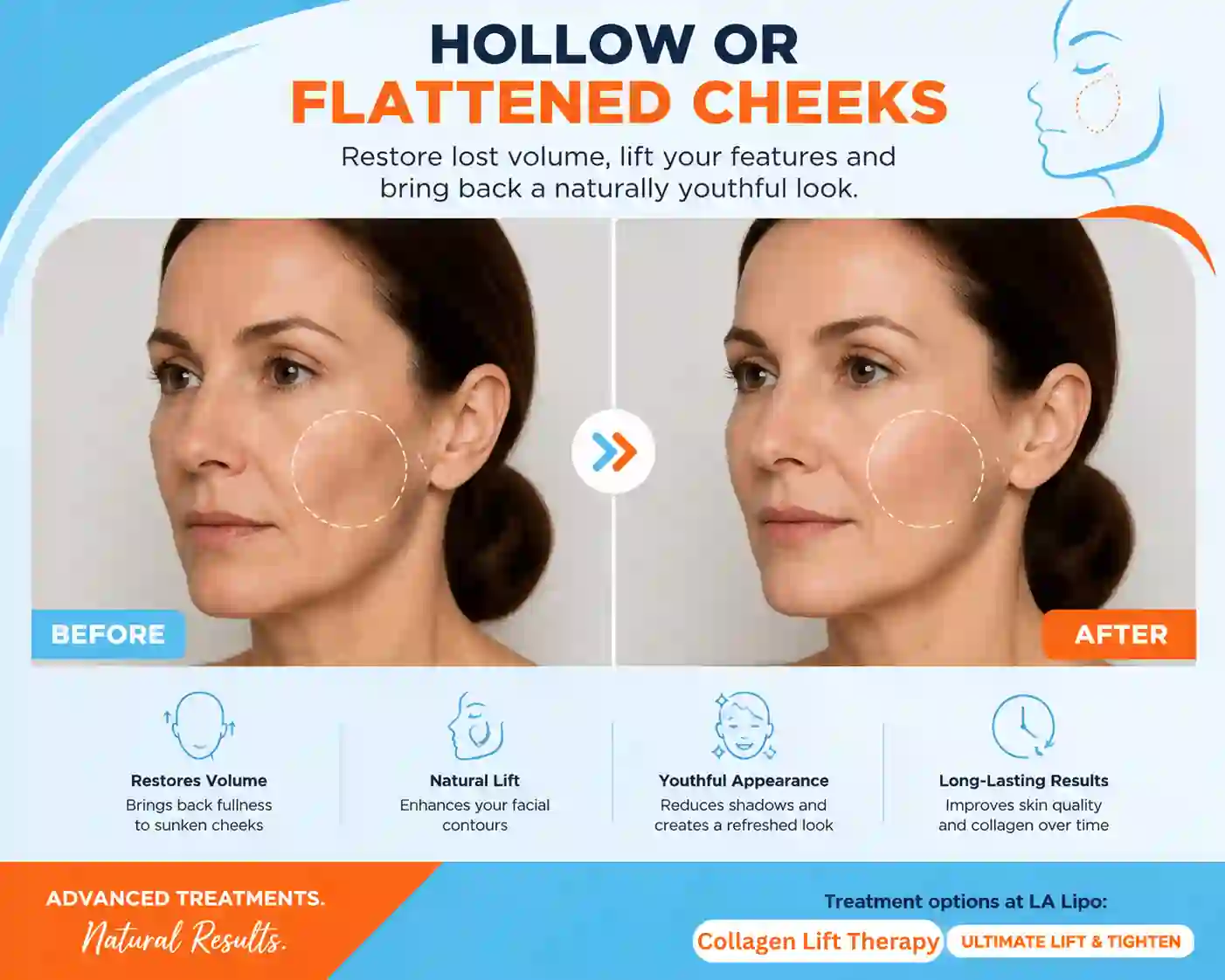 Sign #4: Hollow or Flattened Cheeks Morden