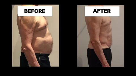 What Symptoms Can Diastasis Recti Cause in Men? Weak Core, Back Pain and Poor Posture Morden